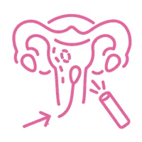 Hysteroscopy Surgery